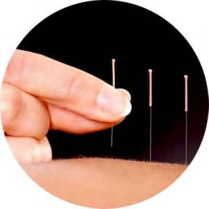 Acupuncture Treatment with Needle