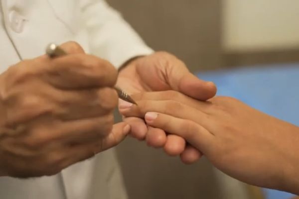 Prickling neuro stimulation technique ( PNST)